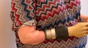 Mujer recibe con éxito una mano robótica revolucionaria