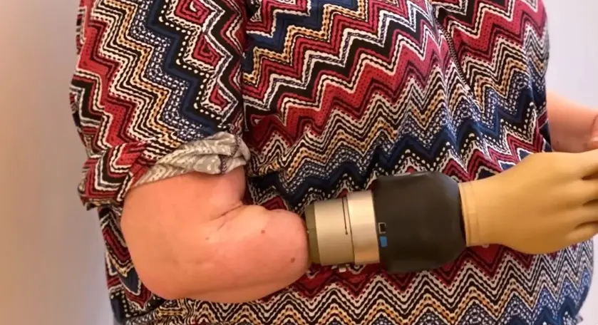 Woman Receives First Successful Robotic Hand Implant